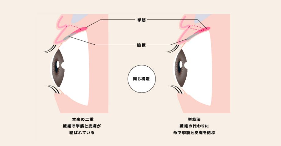 奈良県橿原市の埋没法で二重整形