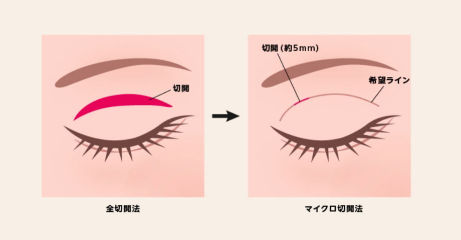 奈良県橿原市の二重整形「小切開」