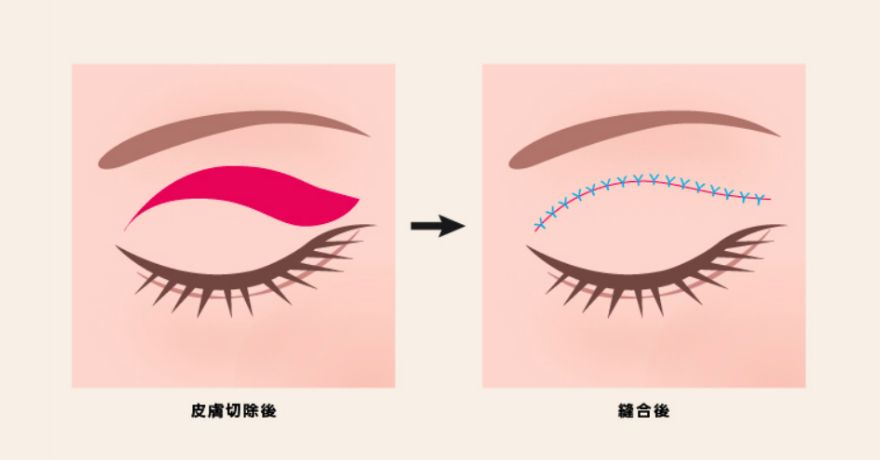 奈良県橿原市の「挙筋処理なしの場合」上まぶたのたるみを除去挙筋処理なしの場合