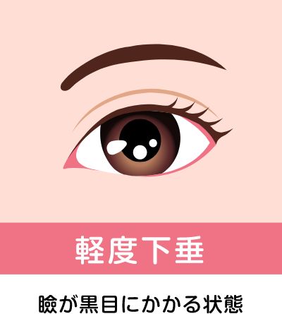 奈良県橿原市の軽度の眼瞼下垂