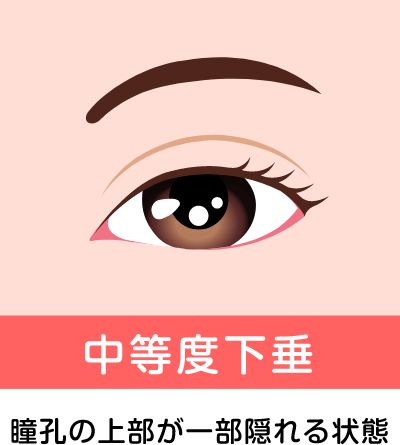 奈良県橿原市の中度の眼瞼下垂