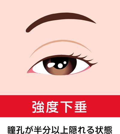 奈良県橿原市の強度の眼瞼下垂