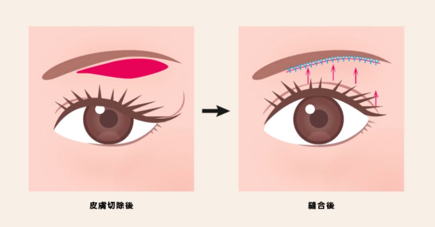 奈良県橿原市の「眉下リフト」は上まぶたのたるみを除去