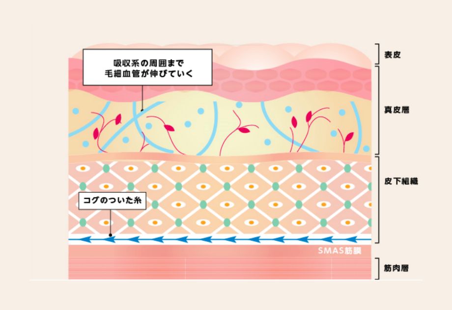 奈良県橿原市のスレッドリフト（糸リフト）のたるみ治療