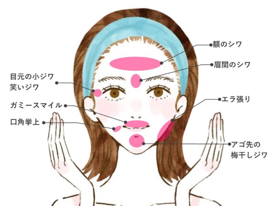 奈良県橿原市の額・眉間・目尻の表情じわ治療『ボトックス注入』