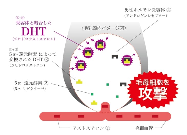 奈良県橿原市の女性の薄毛の原因はテストステロン